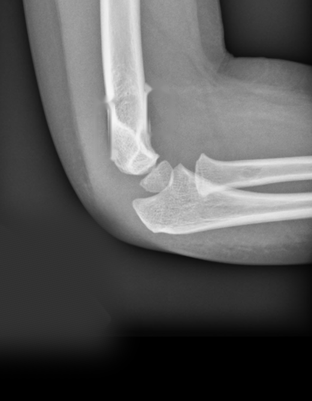 Radiographie de coude de profil