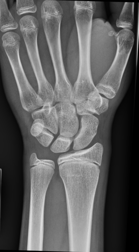 Radiographie de poignet