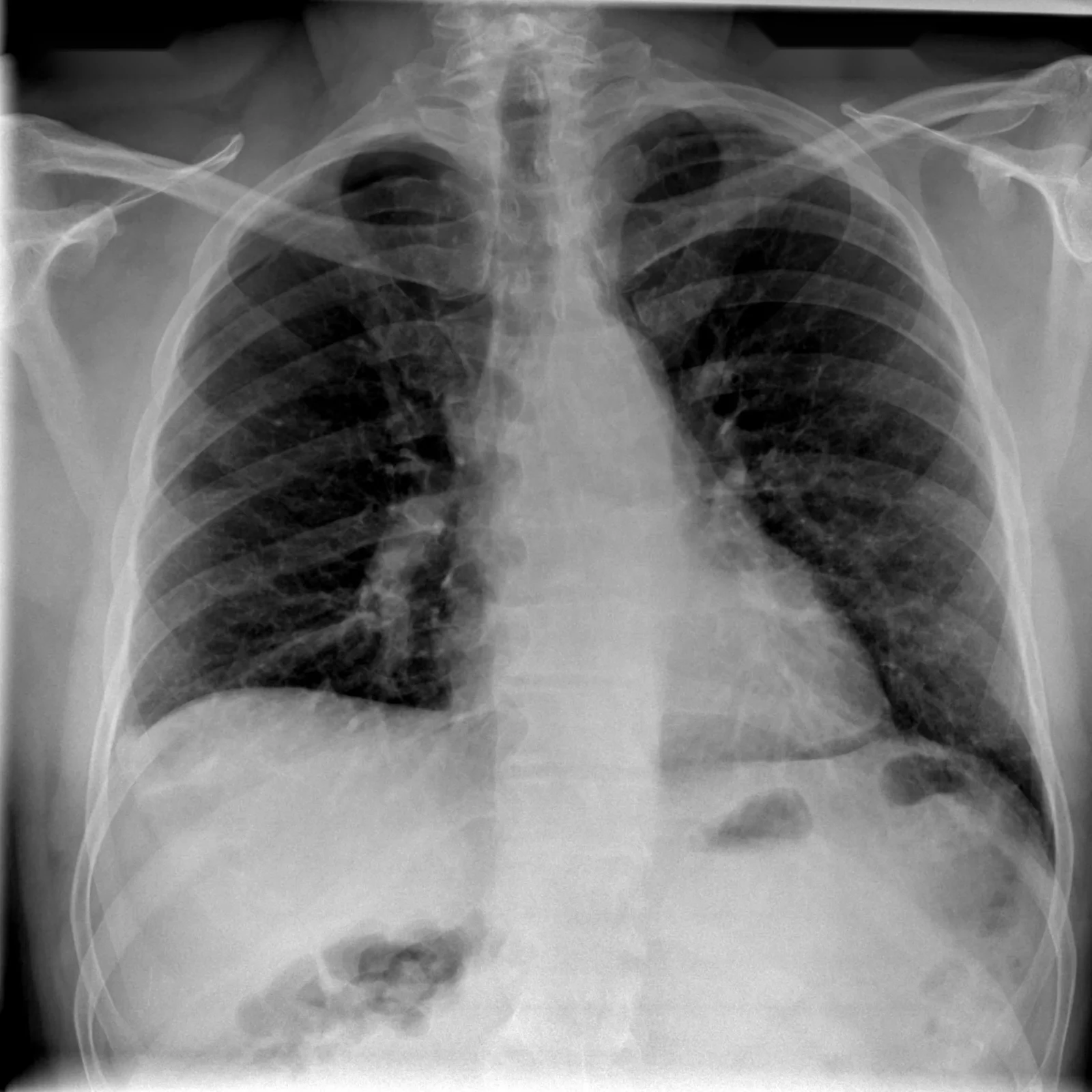 Radiographie de thorax