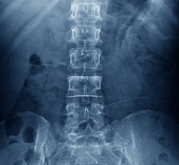 Radiographie du rachis lombaire